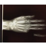 Hand Trauma