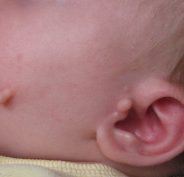 Branchial Cleft