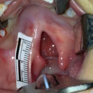 Cleft Palate