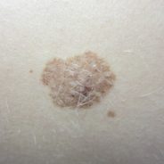 Congenital Nevus (moles)