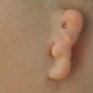Microtia (small or absent ear)