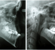 Midface Hypoplasia