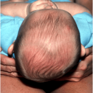Deformational Plagiocephaly