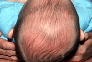 Deformational Plagiocephaly