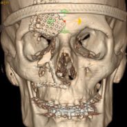 Facial Fractures