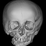 Mandibular Hypoplasia